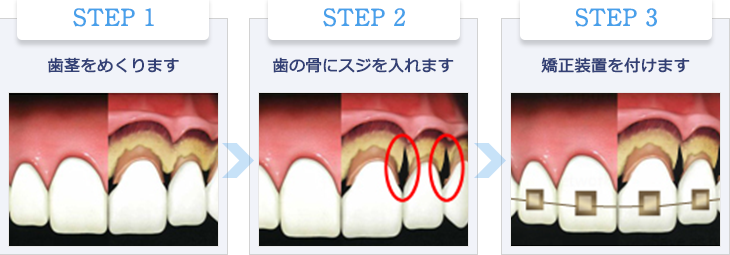 骨にスジを入れ、歯を動かす治療法