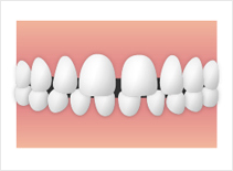 空隙歯列