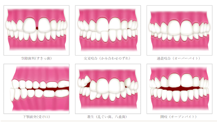 治療可能な歯並び