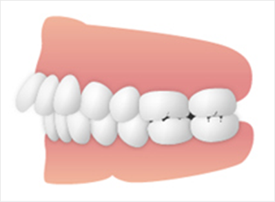 上顎前突（出っ歯）