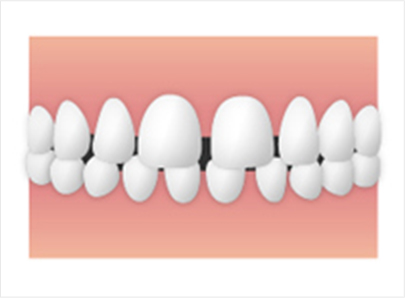 空隙歯列